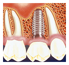 Implants