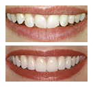 Veneers