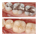 Fillings